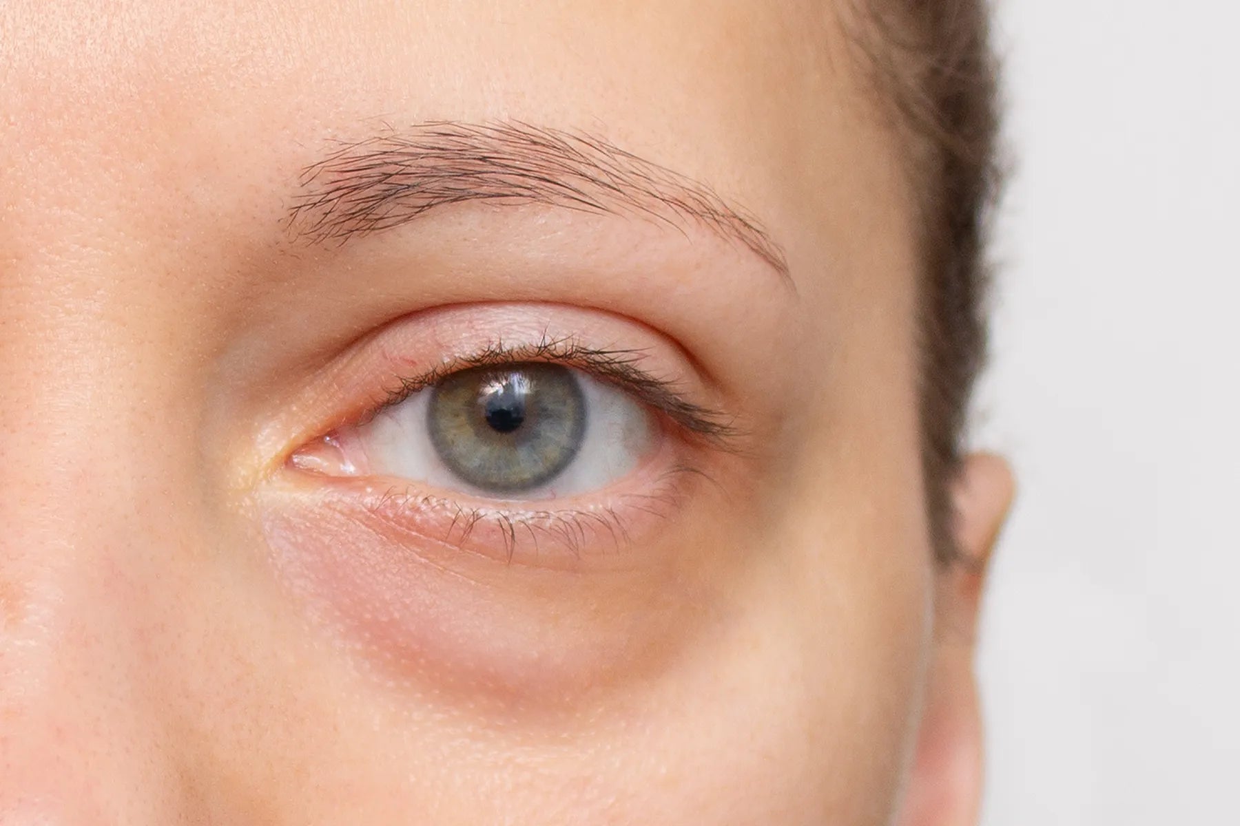 The Mystery of Dark Under-Eye Circles