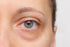 The Mystery of Dark Under-Eye Circles