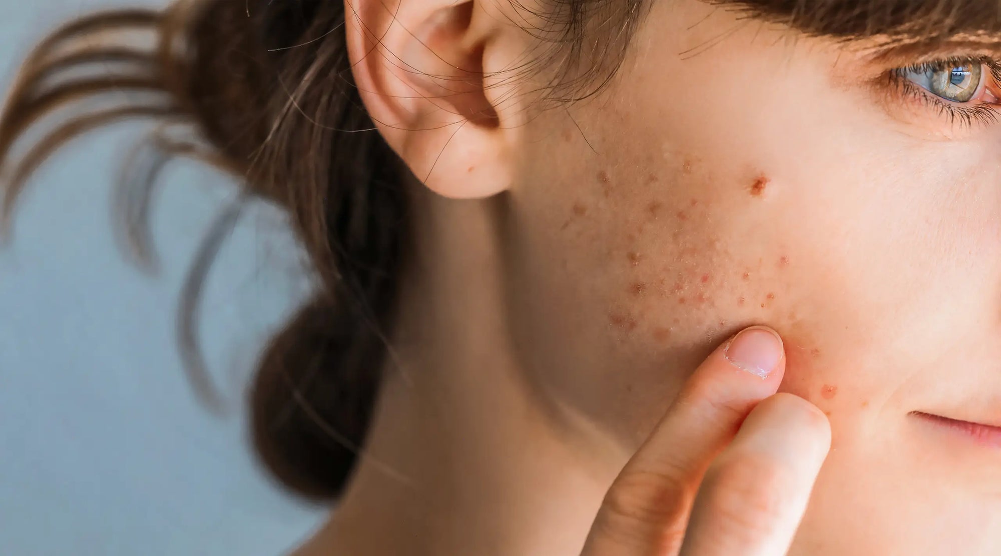 Acne Routine